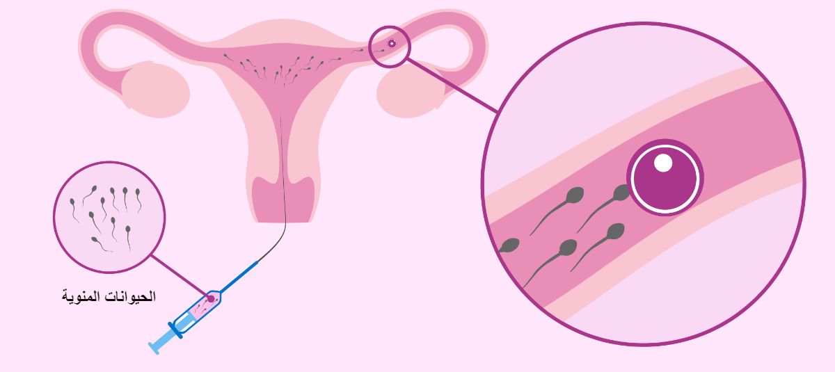 أسعار عملية التلقيح الصناعي