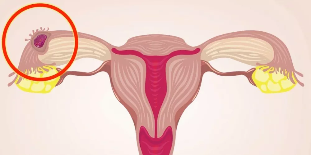 اعراض التصاقات الرحم