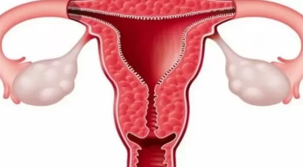 اعراض بطانة الرحم المهاجرة