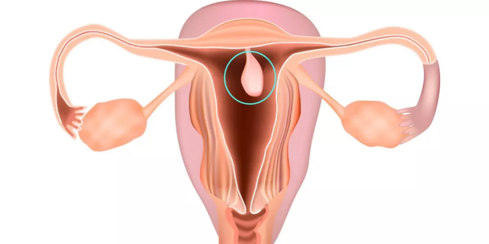 تجربتي مع لحمية الرحم