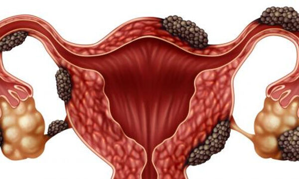 حالات شفيت من بطانة الرحم المهاجرة