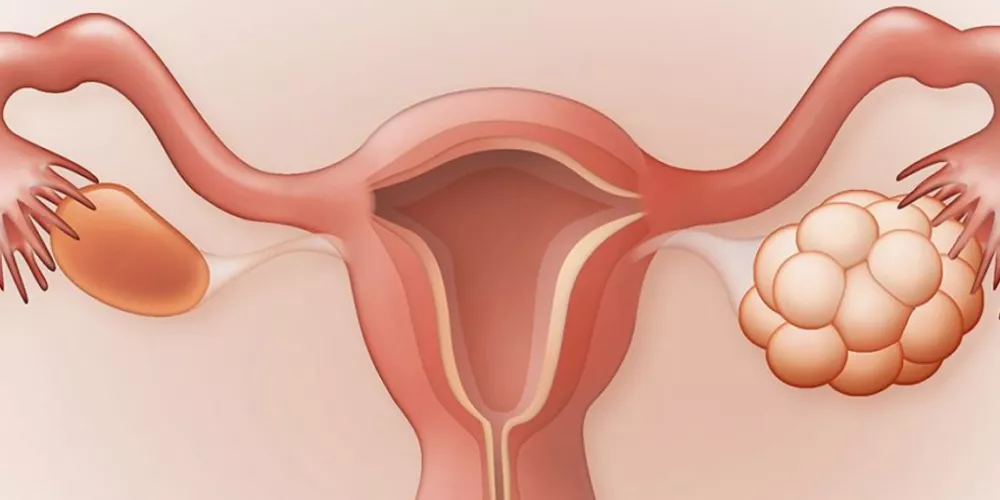 علاج أكياس المبايض عند البنات