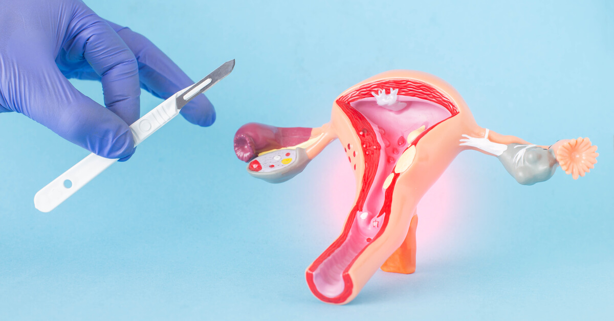 علاج التصاقات الرحم بعد العملية القيصرية