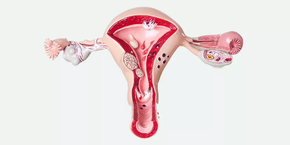 علاج الزوائد اللحمية في الرحم