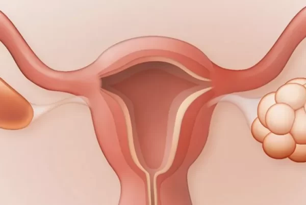 علاج تكيسات المبايض