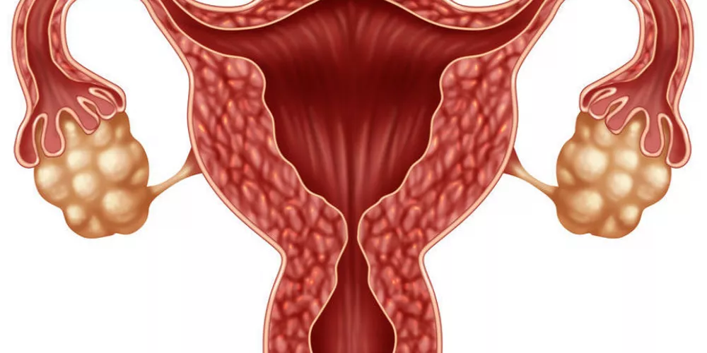 ما هو تكيس المبايض