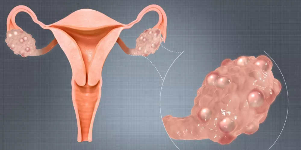 ماهي أكياس المبايض